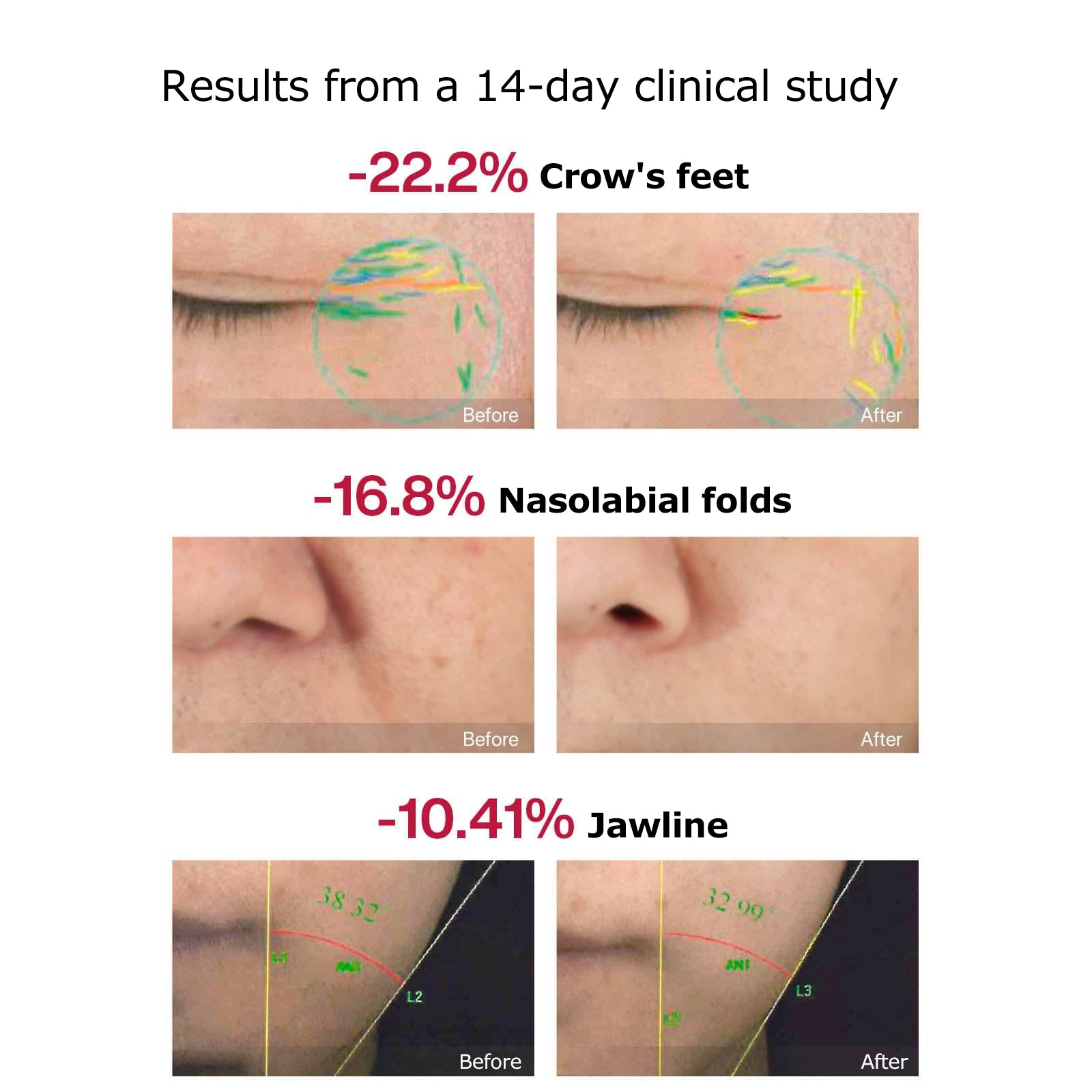 Before and after clinical study results showing reductions in crow's feet, nasolabial folds, and jawline wrinkles.